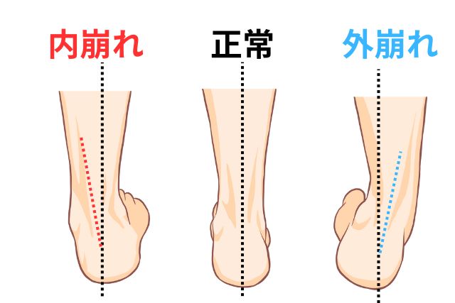 足の崩れ